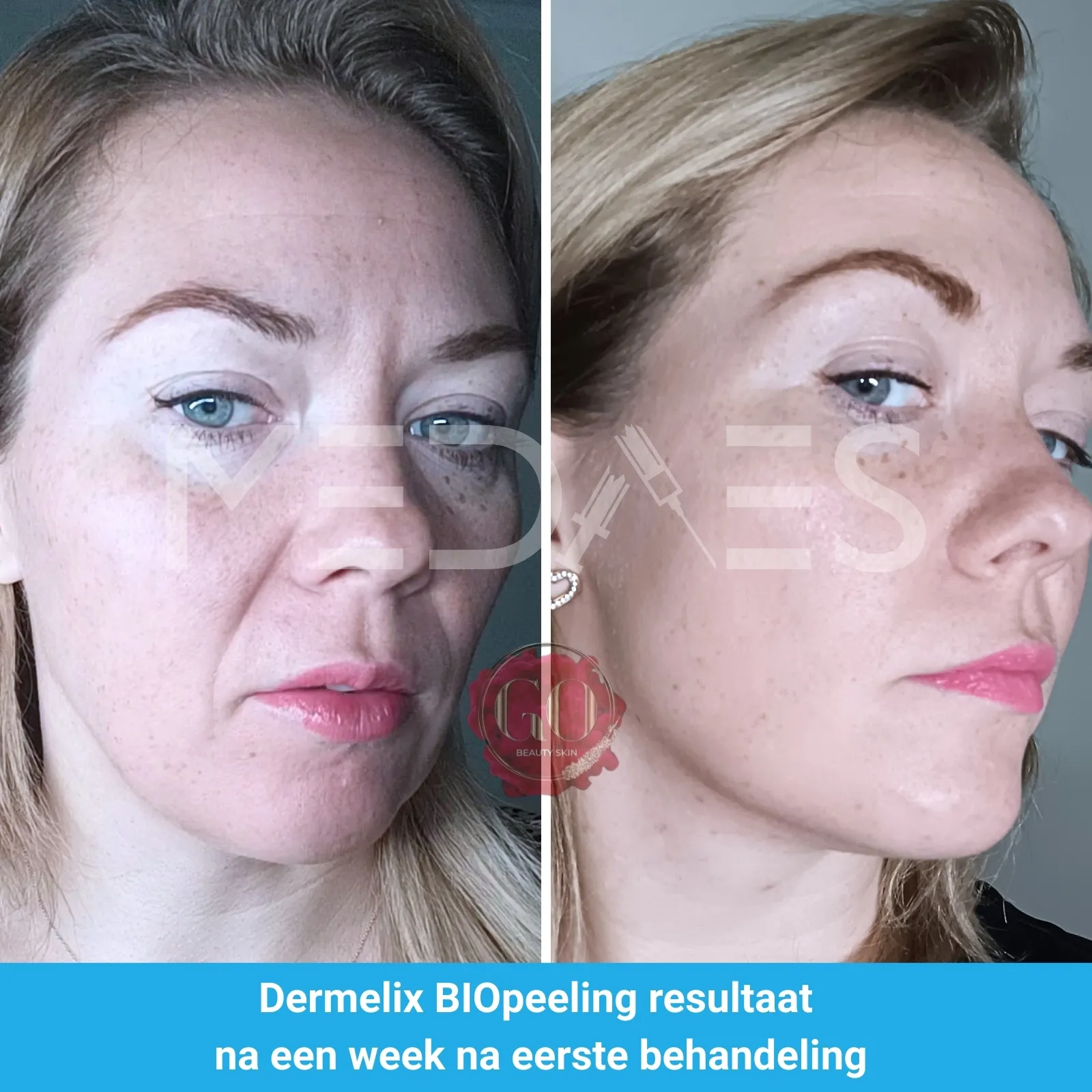 resultaten BioPeelig met Dermelix BP-002 – 60% PMPS Algen Peeling II (Bruin)-Beauty Skin Go-M01-voor en na 1 week na eerste behandeling-01