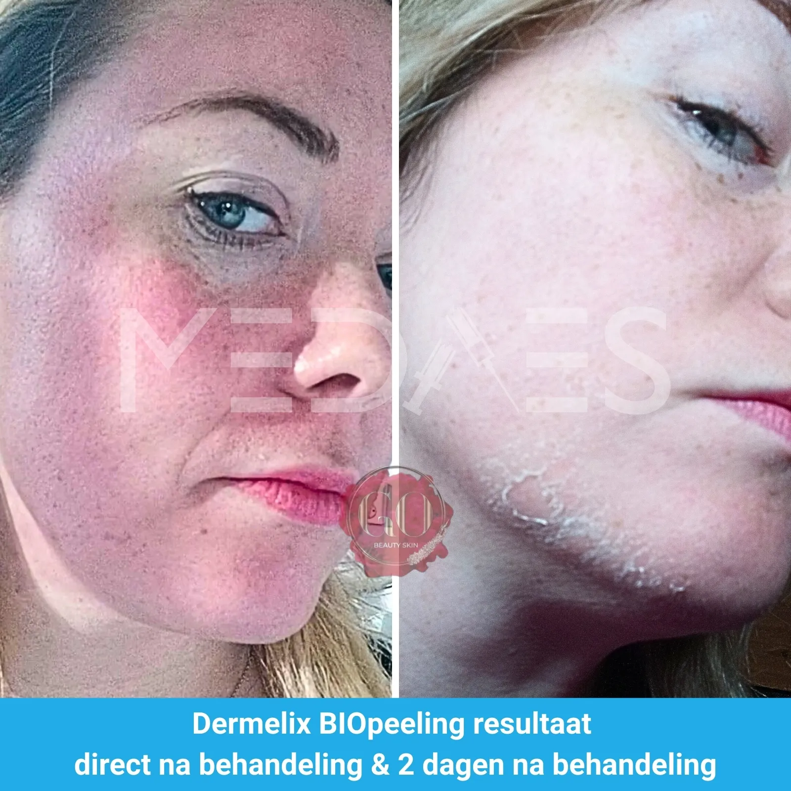 resultaten BioPeelig met Dermelix BP-002 – 60% PMPS Algen Peeling II (Bruin)-Beauty Skin Go-M01-voor en na 2 dagen na behandeling-01