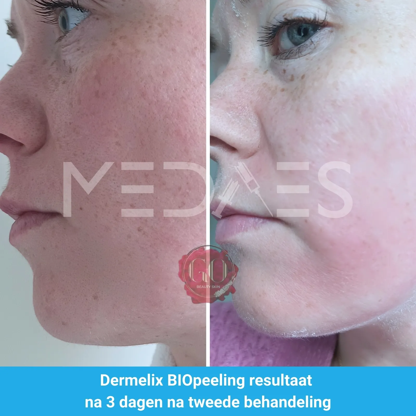 resultaten BioPeelig met Dermelix BP-002 – 60% PMPS Algen Peeling II (Bruin)-Beauty Skin Go-M01-voor en na 3 dagen na tweede behandeling-01