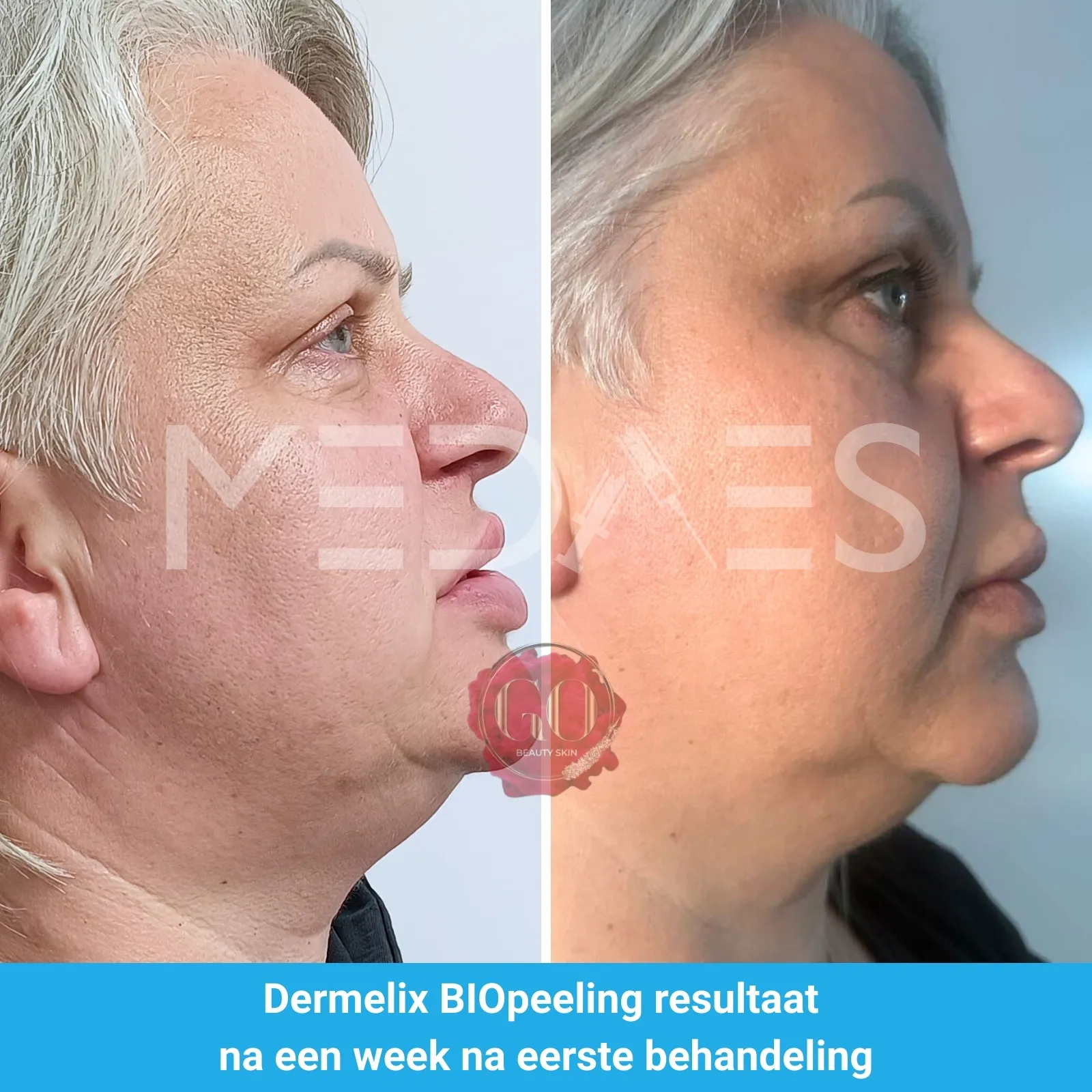 resultaten BioPeelig met Dermelix BP-002 – 60% PMPS Algen Peeling II (Bruin)-Beauty Skin Go-M02-voor en na 1 week na eerste behandeling-01