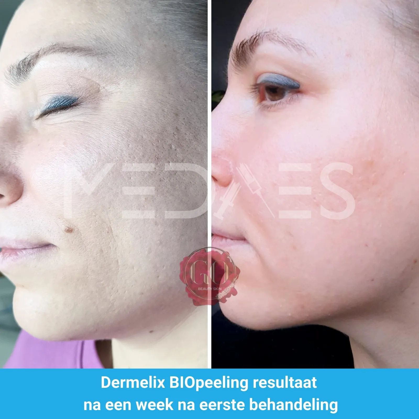 resultaten BioPeelig met Dermelix BP-002 – 60% PMPS Algen Peeling II (Bruin)-Beauty Skin Go-M03-voor en na 1 week na eerste behandeling-01