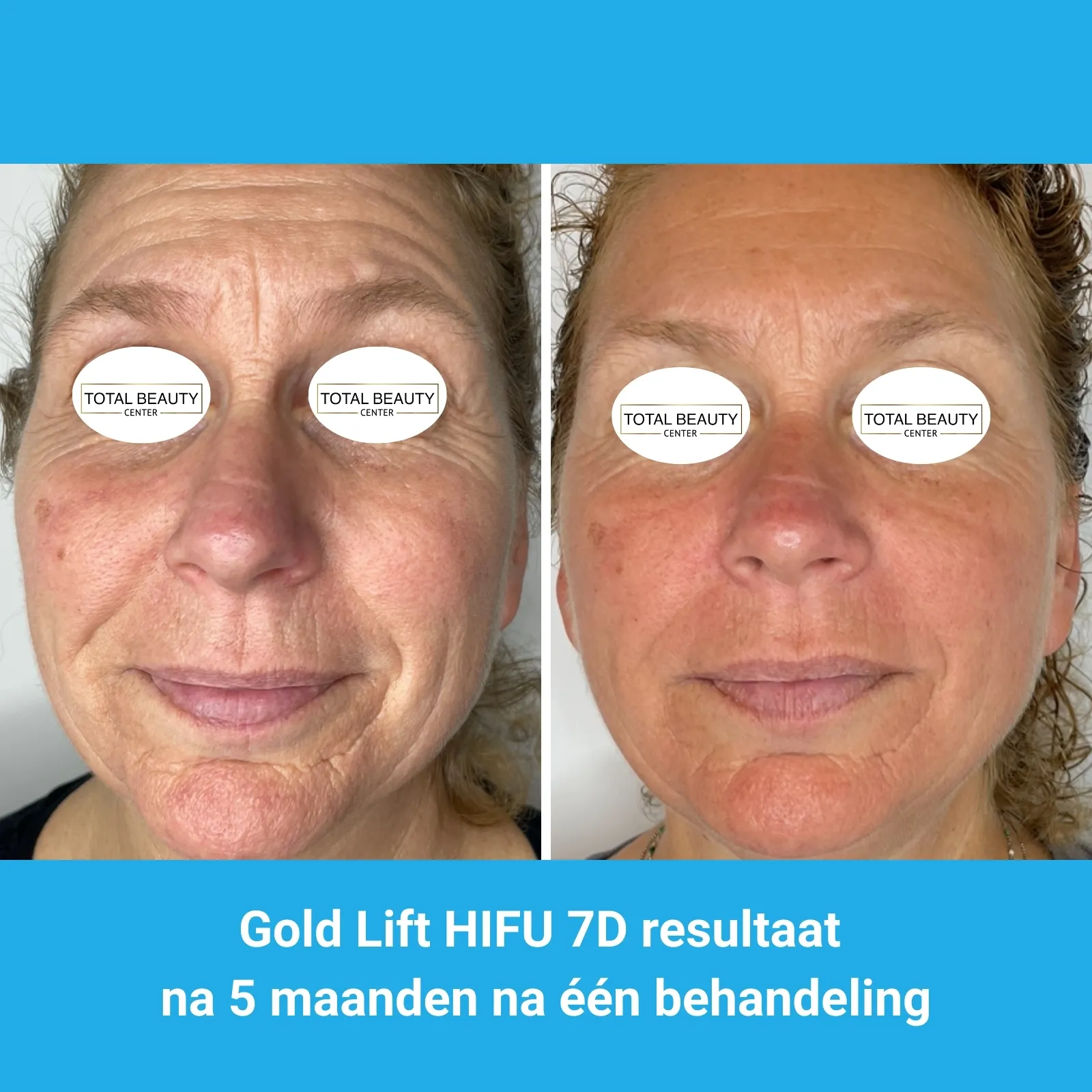 resultaten HIFU met MedAes HIFU 7D-Total Beauty Center-M01-voor en na 5 maanden na behandeling-01