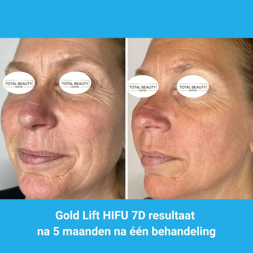 resultaten HIFU met MedAes HIFU 7D-Total Beauty Center-M01-voor en na 5 maanden na behandeling-02
