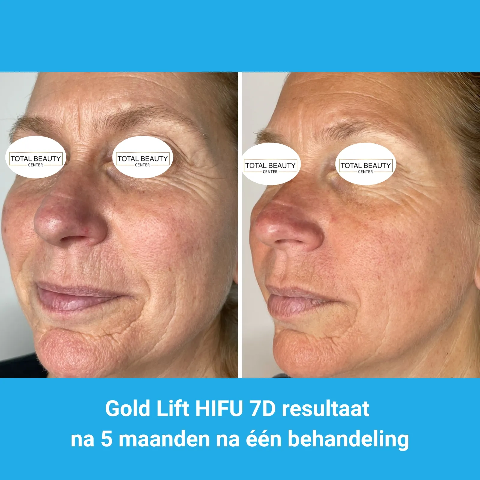 resultaten HIFU met MedAes HIFU 7D-Total Beauty Center-M01-voor en na 5 maanden na behandeling-02