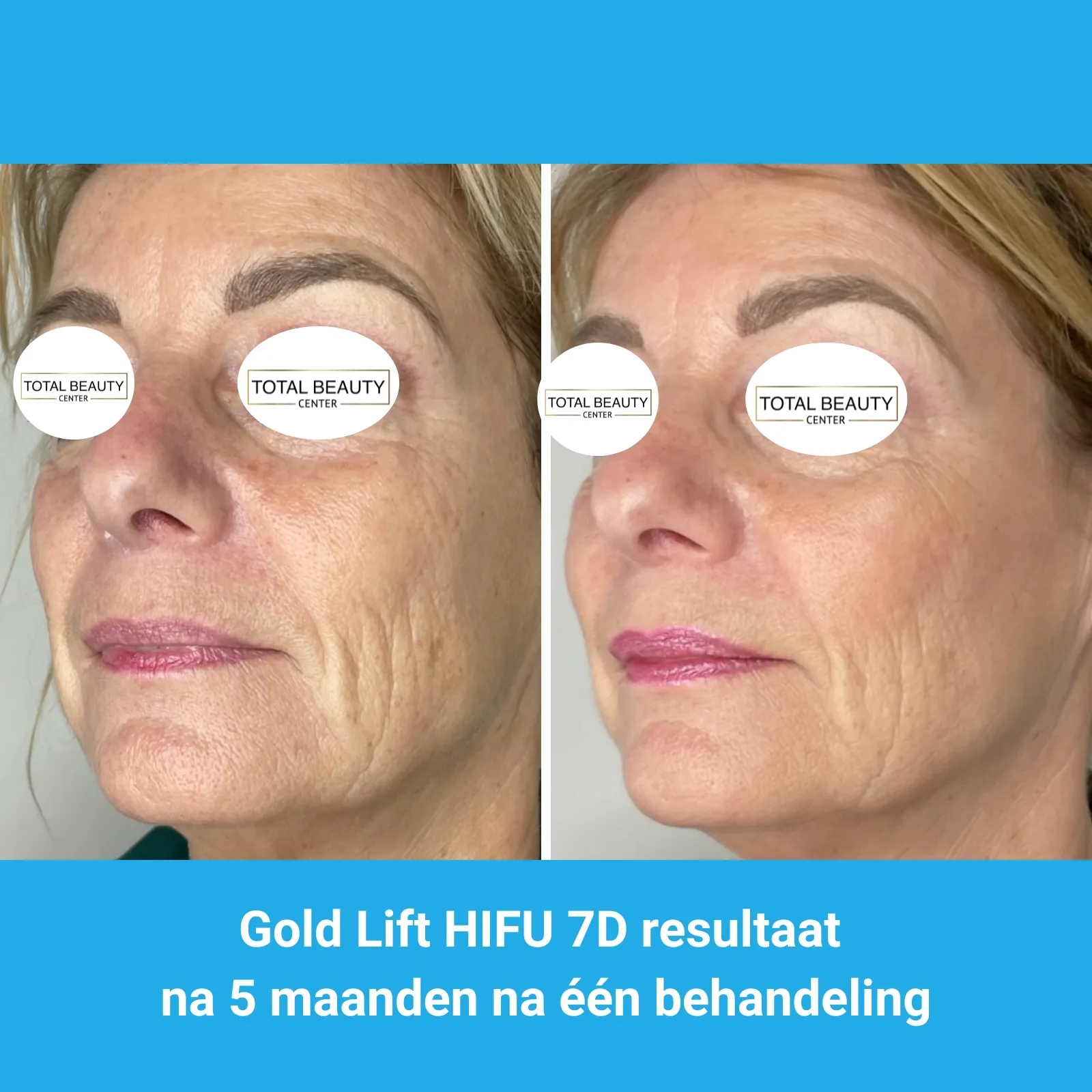 resultaten HIFU met MedAes HIFU 7D-Total Beauty Center-M02-voor en na 5 maanden na behandeling-01