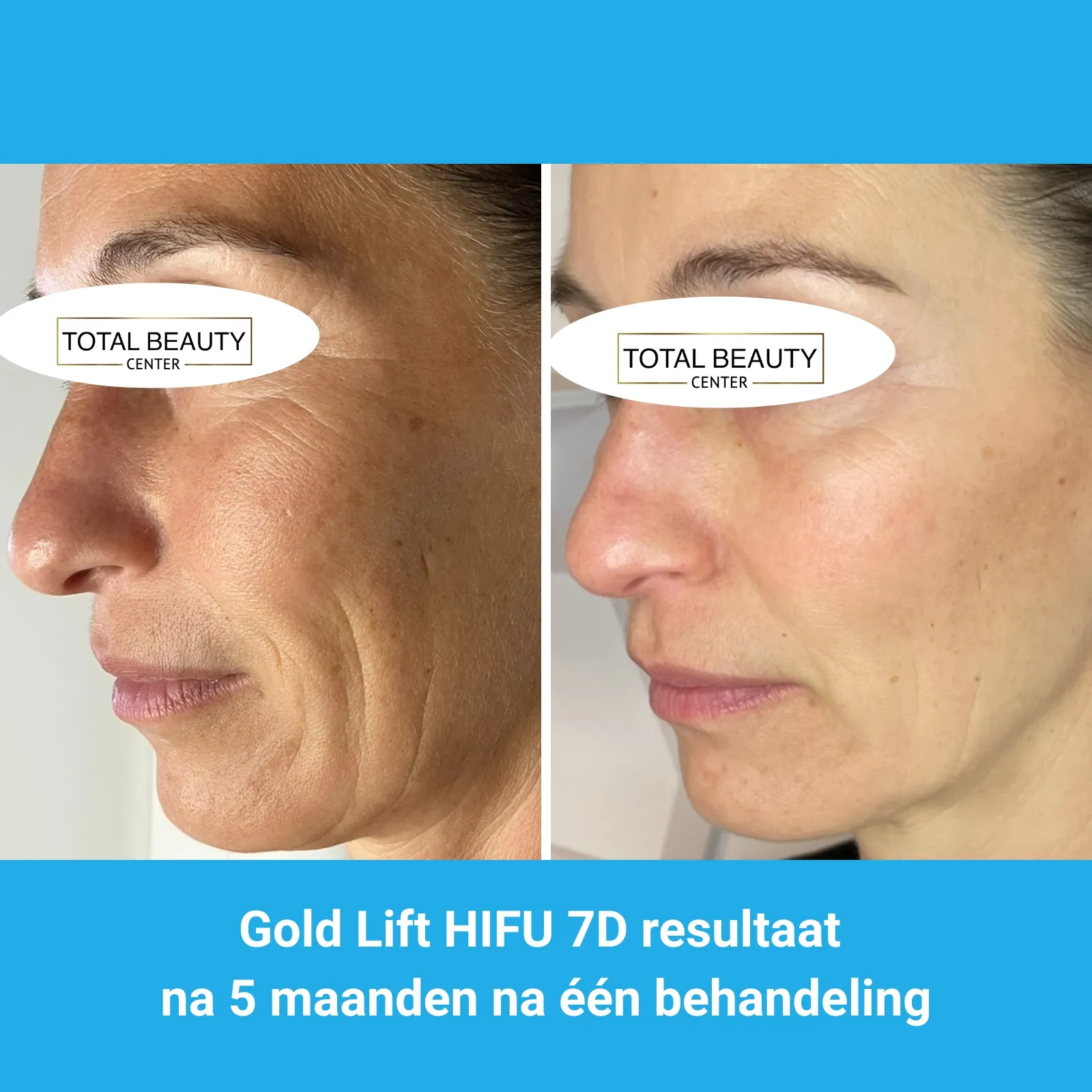 resultaten HIFU met MedAes HIFU 7D-Total Beauty Center-M03-voor en na 5 maanden na behandeling-01