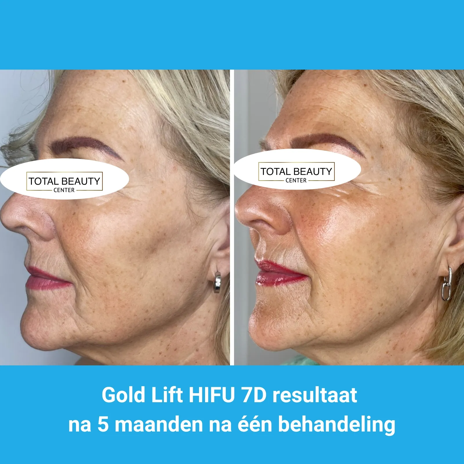 resultaten HIFU met MedAes HIFU 7D-Total Beauty Center-M04-voor en na 5 maanden na behandeling-01