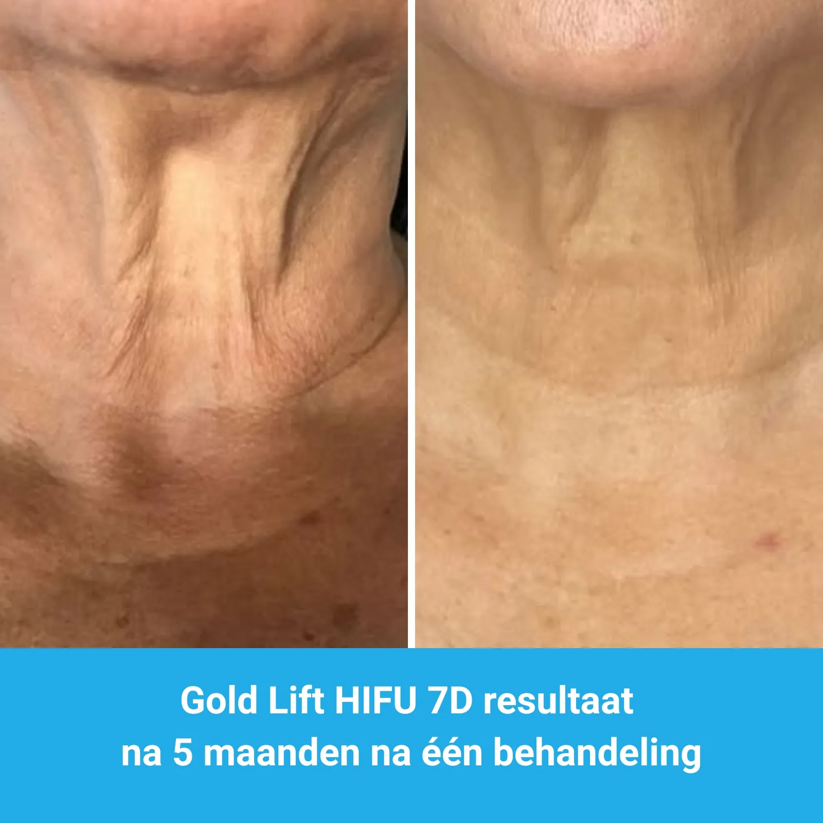 resultaten HIFU met MedAes HIFU 7D-Total Beauty Center-M05-voor en na 5 maanden na behandeling-01