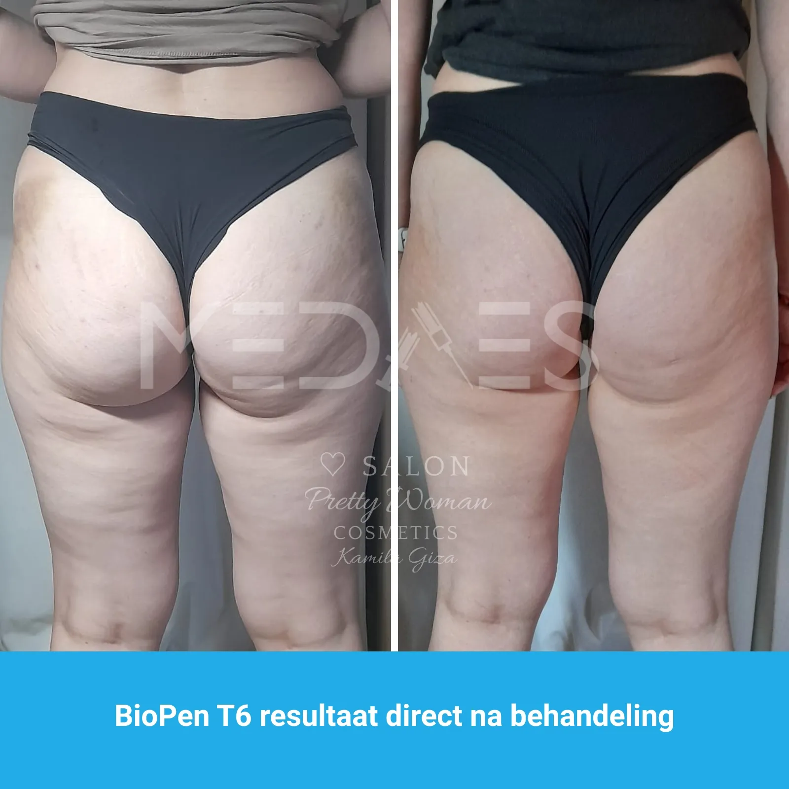 resultaten billen lifting met BioPen T6-SALON PRETTY WOMAN-M06-voor en direct na behandeling-01