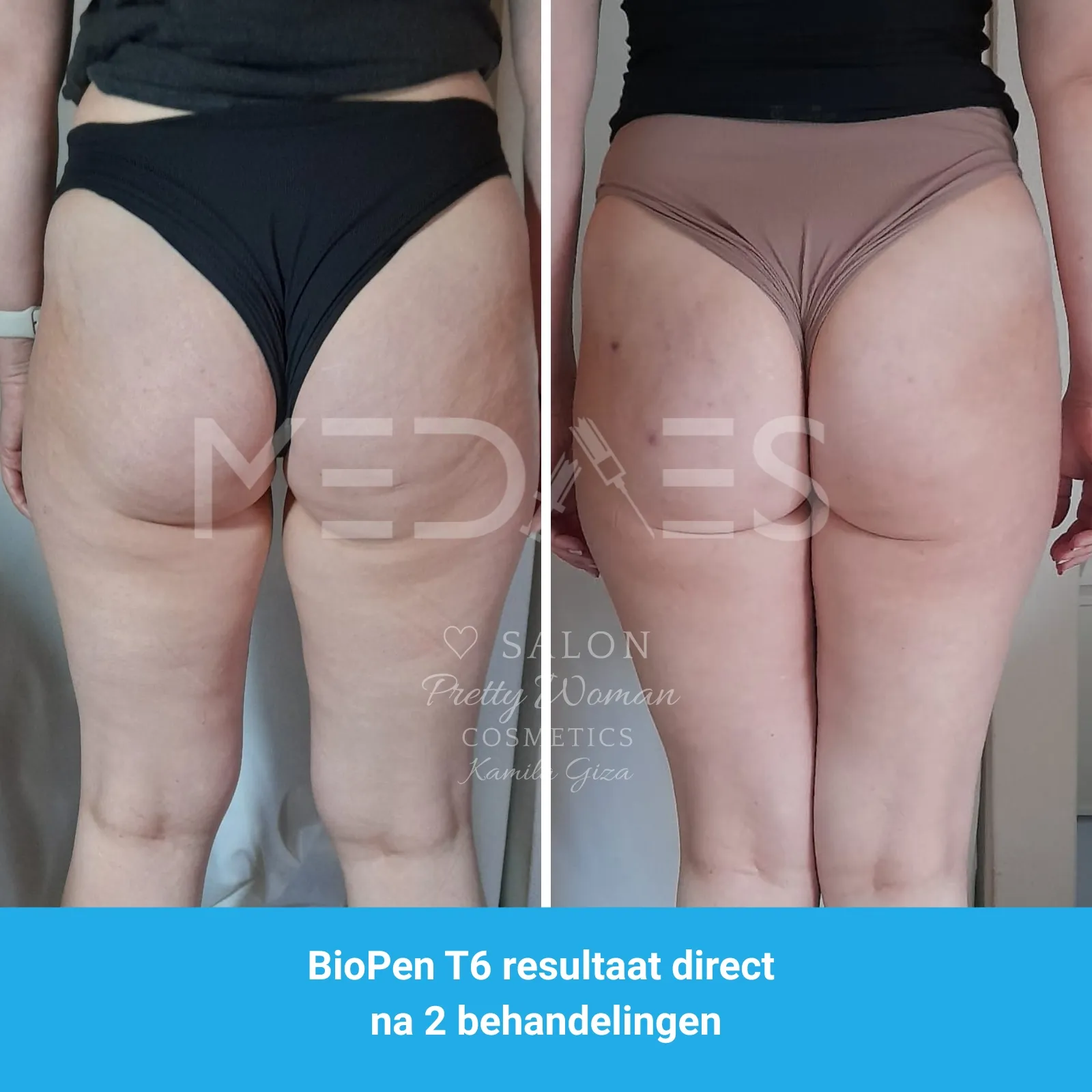 resultaten billen lifting met BioPen T6-SALON PRETTY WOMAN-M06-voor en direct na tweede behandeling-02