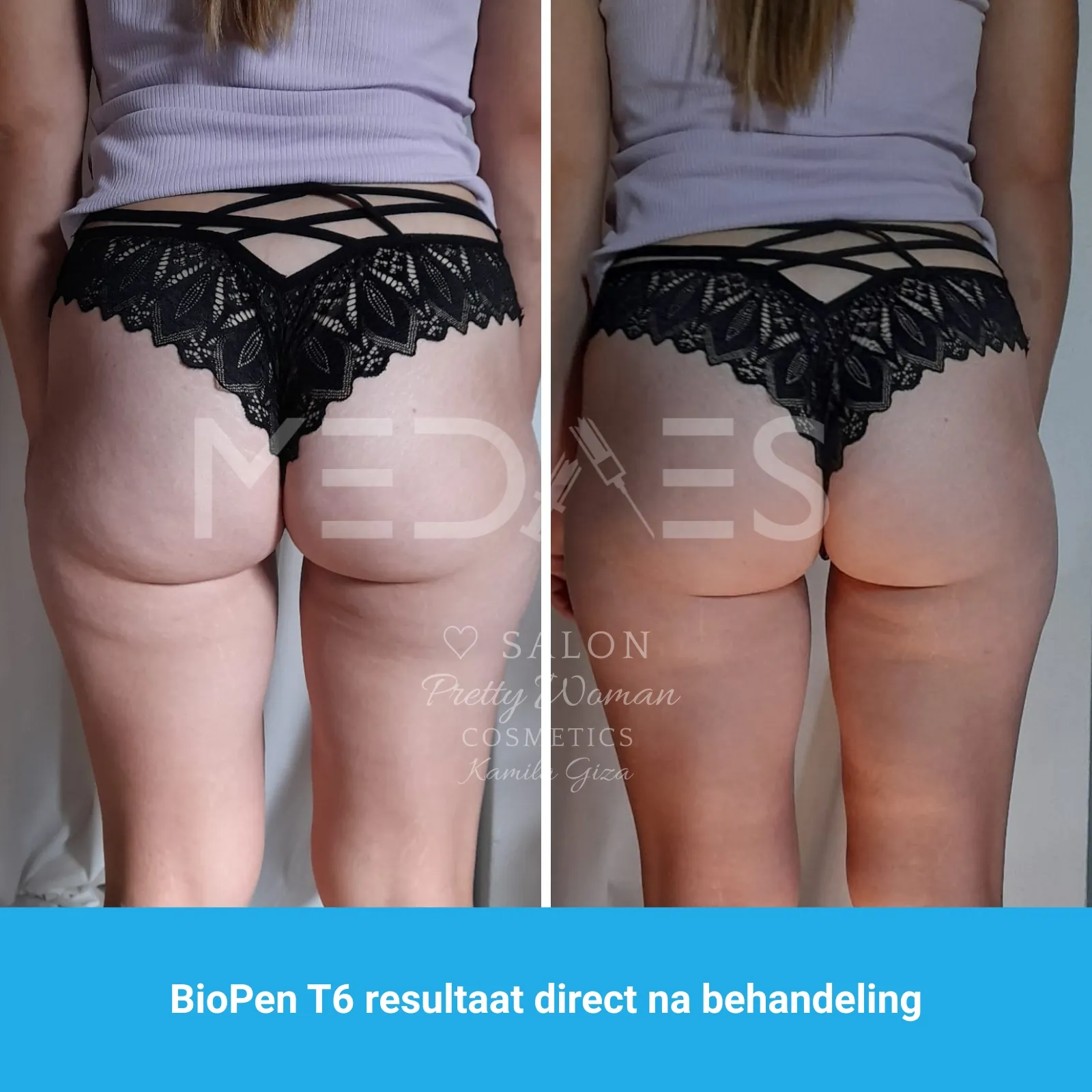 resultaten billen lifting met BioPen T6-SALON PRETTY WOMAN-M07-voor en direct na behandeling-01