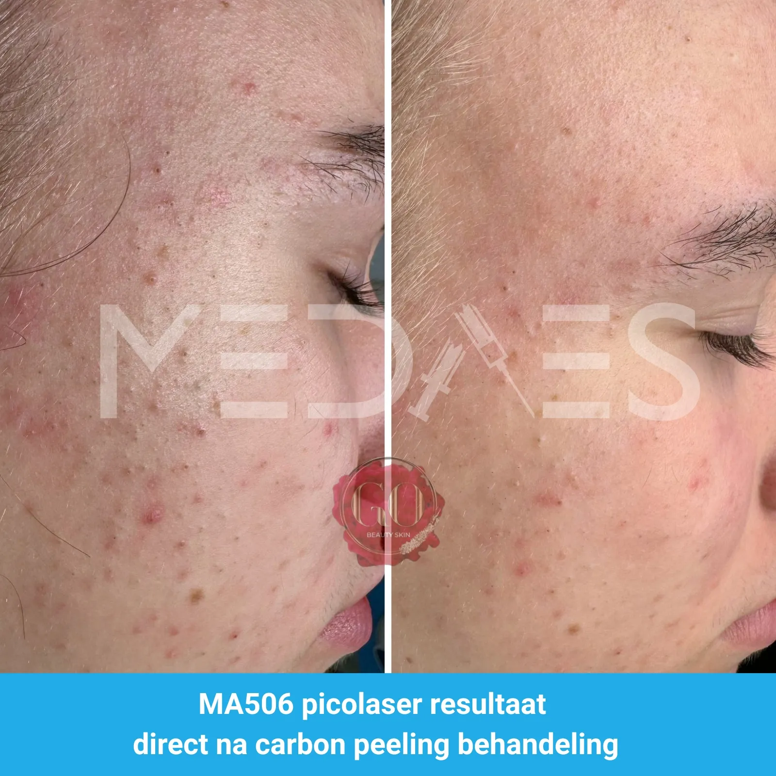 resultaten carbon peeling met MA506A picolaser van MedAes Beauty Skin Go-M03-voor en direct na behandeling-01 resultaten carbon peeling met MA506A picolaser van MedAes Beauty Skin Go-M03-voor en direct na behandeling-01