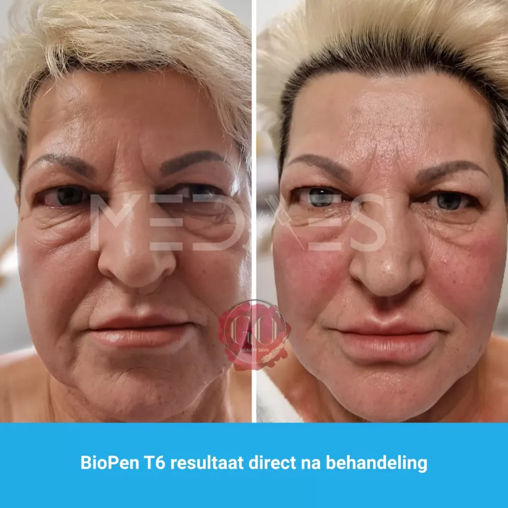 resultaten gezicht lifting met BioPen T6-Beauty Skin Go-M01-voor en direct na tweede behandeling-02 resultaten gezicht lifting met BioPen T6-Beauty Skin Go-M01-voor en direct na tweede behandeling-02