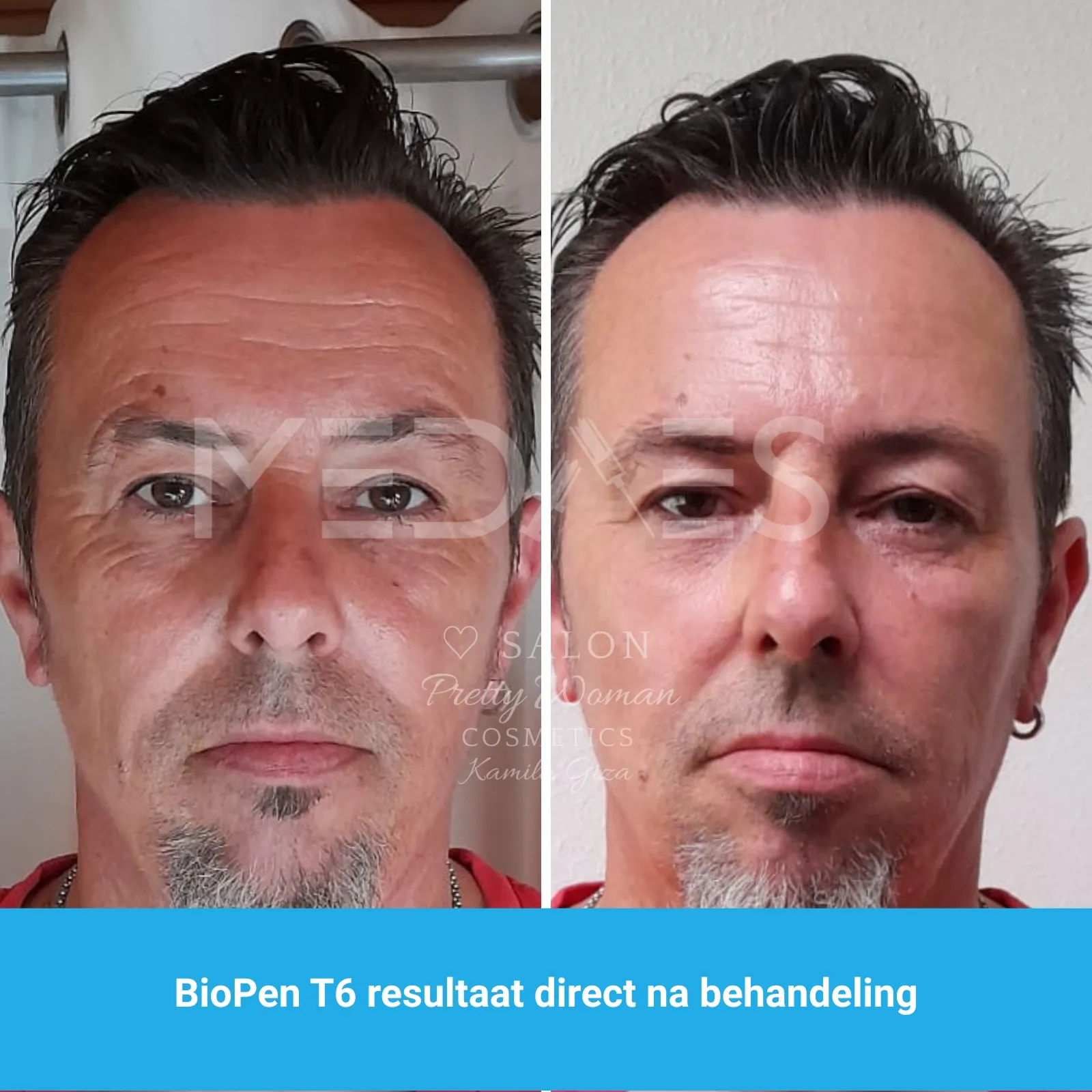 resultaten gezicht lifting met BioPen T6-SALON PRETTY WOMAN-M01-voor en direct na behandeling-01