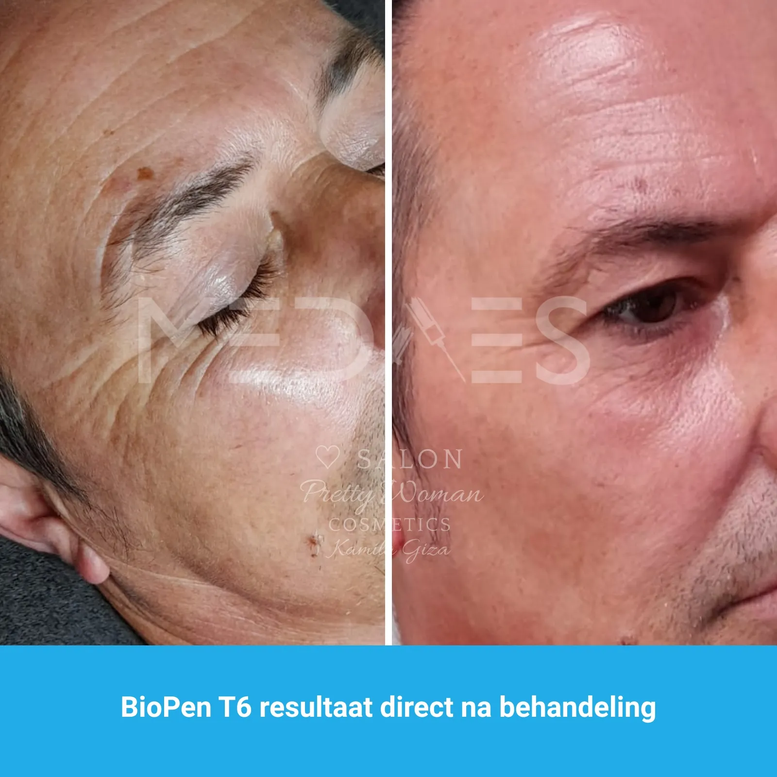 resultaten gezicht lifting met BioPen T6-SALON PRETTY WOMAN-M01-voor en direct na behandeling-02