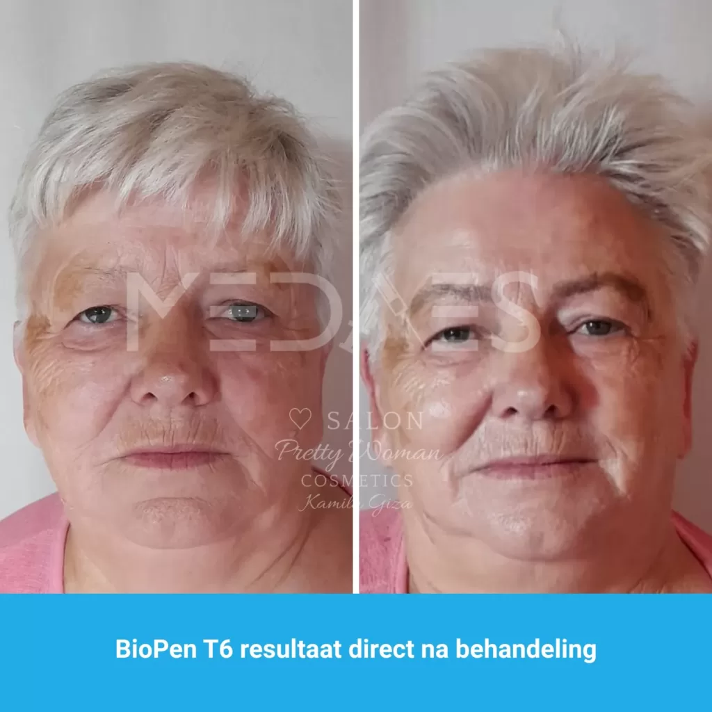 resultaten gezicht lifting met BioPen T6-SALON PRETTY WOMAN-M03-voor en direct na behandeling-01 resultaten gezicht lifting met BioPen T6-SALON PRETTY WOMAN-M03-voor en direct na behandeling-01