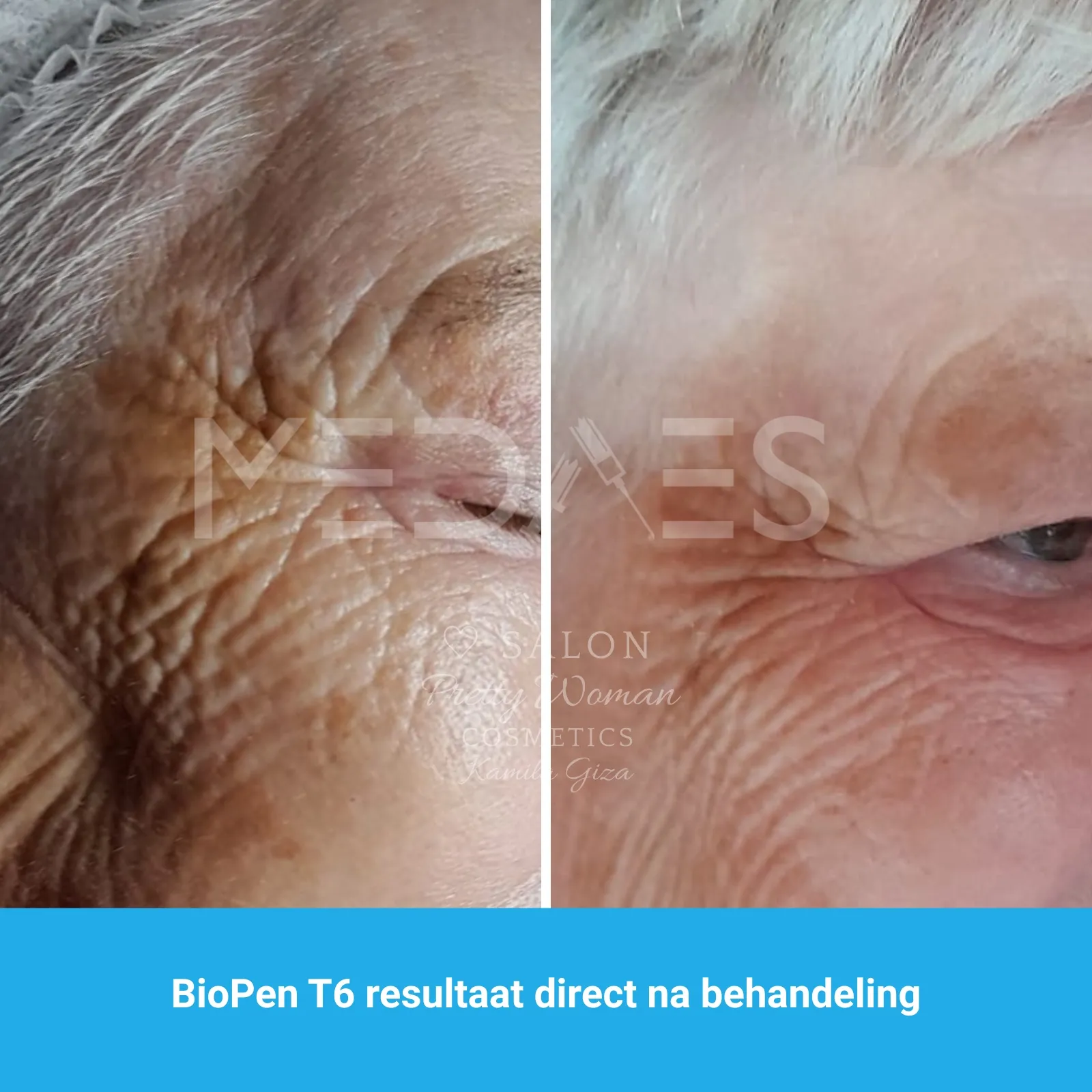 resultaten gezicht lifting met BioPen T6-SALON PRETTY WOMAN-M03-voor en direct na behandeling-02