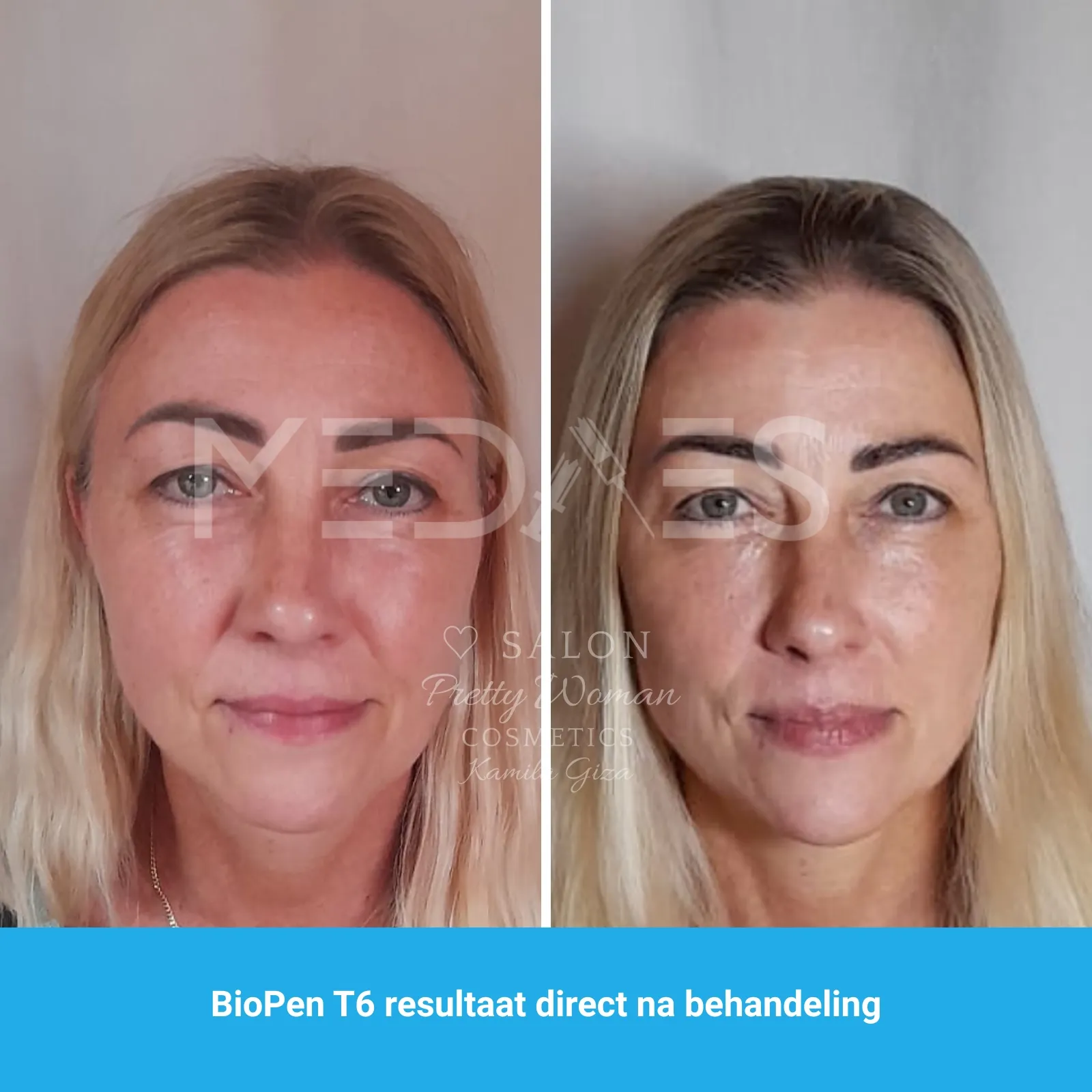 resultaten gezicht lifting met BioPen T6-SALON PRETTY WOMAN-M04-voor en direct na behandeling-01