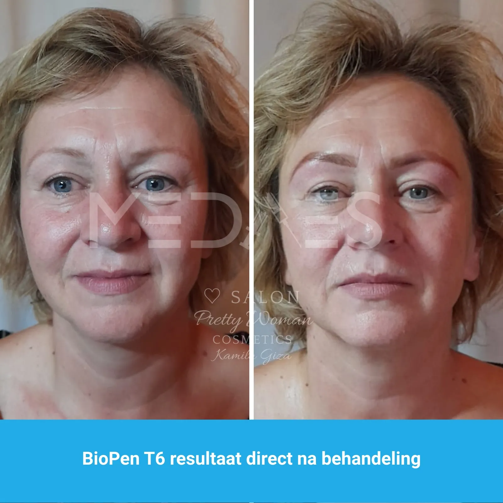 resultaten gezicht lifting met BioPen T6-SALON PRETTY WOMAN-M05-voor en direct na behandeling-01