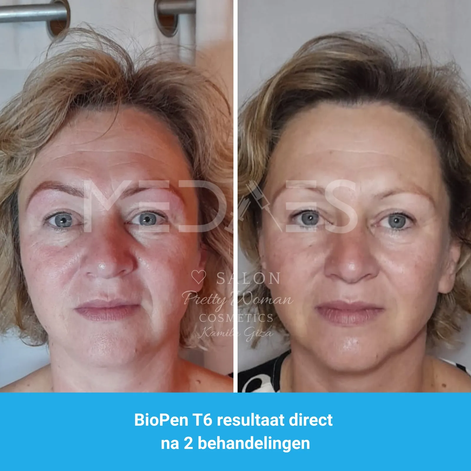resultaten gezicht lifting met BioPen T6-SALON PRETTY WOMAN-M05-voor en direct na tweede behandeling-02