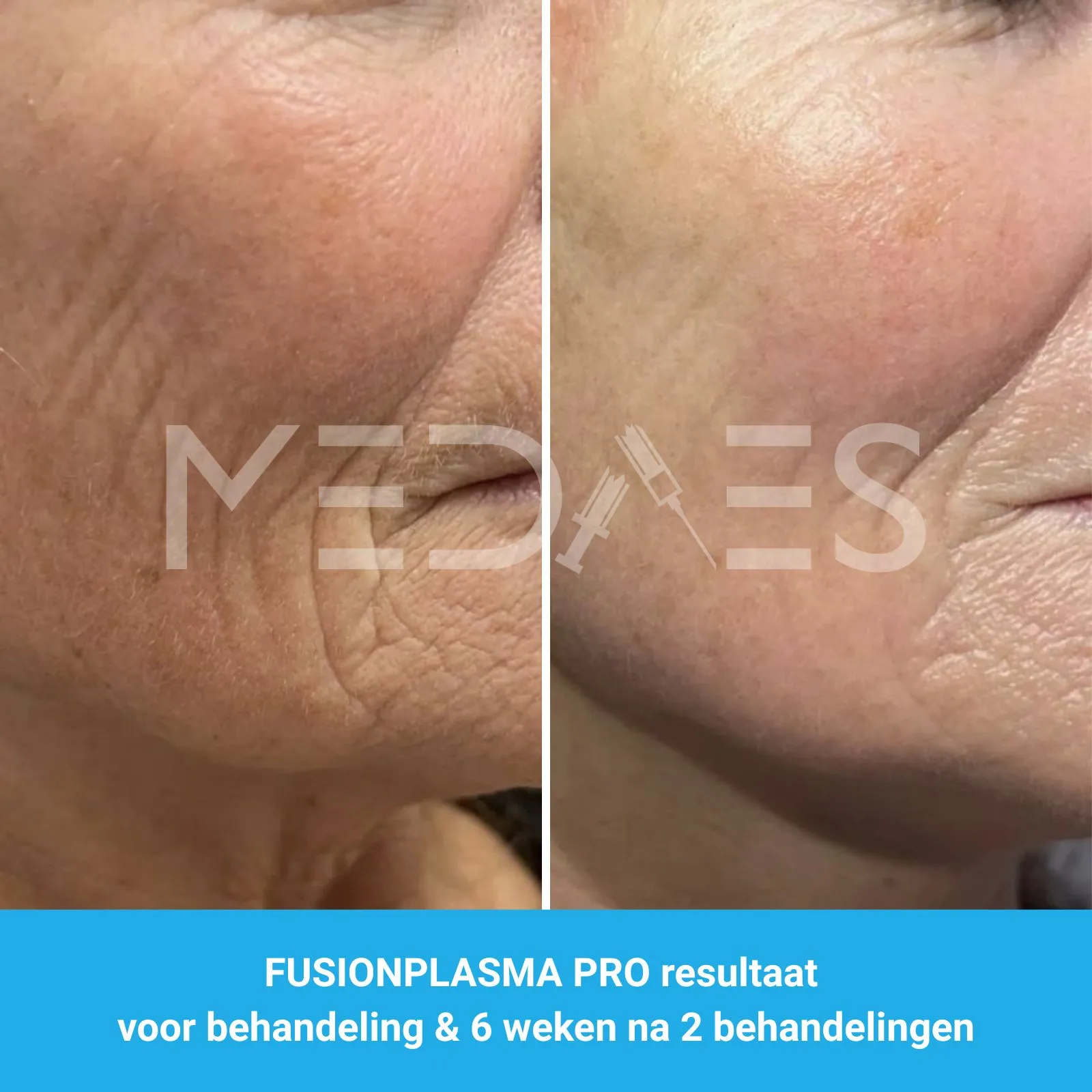 resultaten gezicht rejuvenation met FusionPlasma Pro van MedAes- M03- voor behandeling & 6 weken na 2 behandelingen foto 2 resultaten gezicht rejuvenation met FusionPlasma Pro van MedAes- M03- voor behandeling & 6 weken na 2 behandelingen foto 2