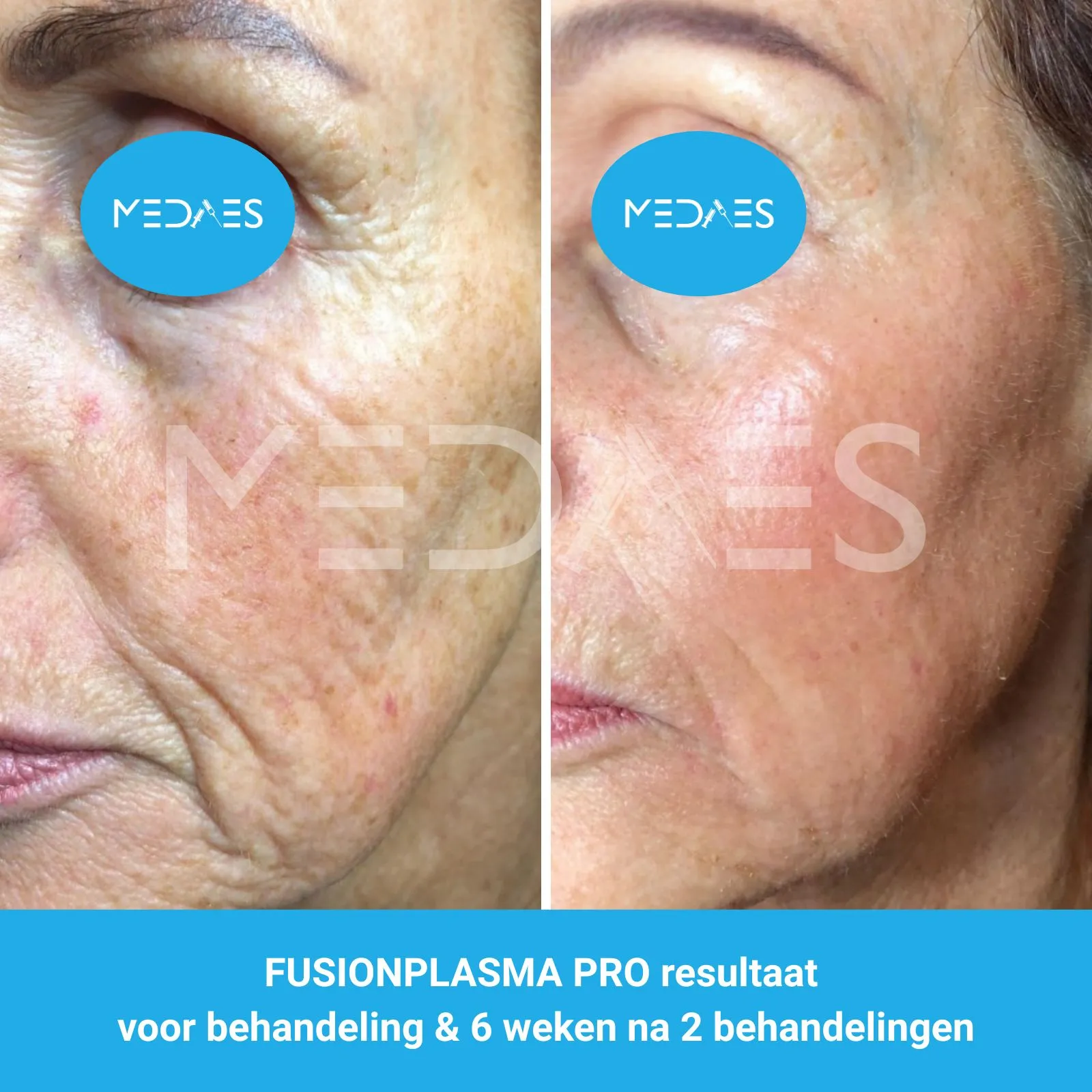 resultaten gezicht rejuvenation met FusionPlasma Pro van MedAes- M03- voor behandeling & 6 weken na 2 behandelingen resultaten gezicht rejuvenation met FusionPlasma Pro van MedAes- M03- voor behandeling & 6 weken na 2 behandelingen