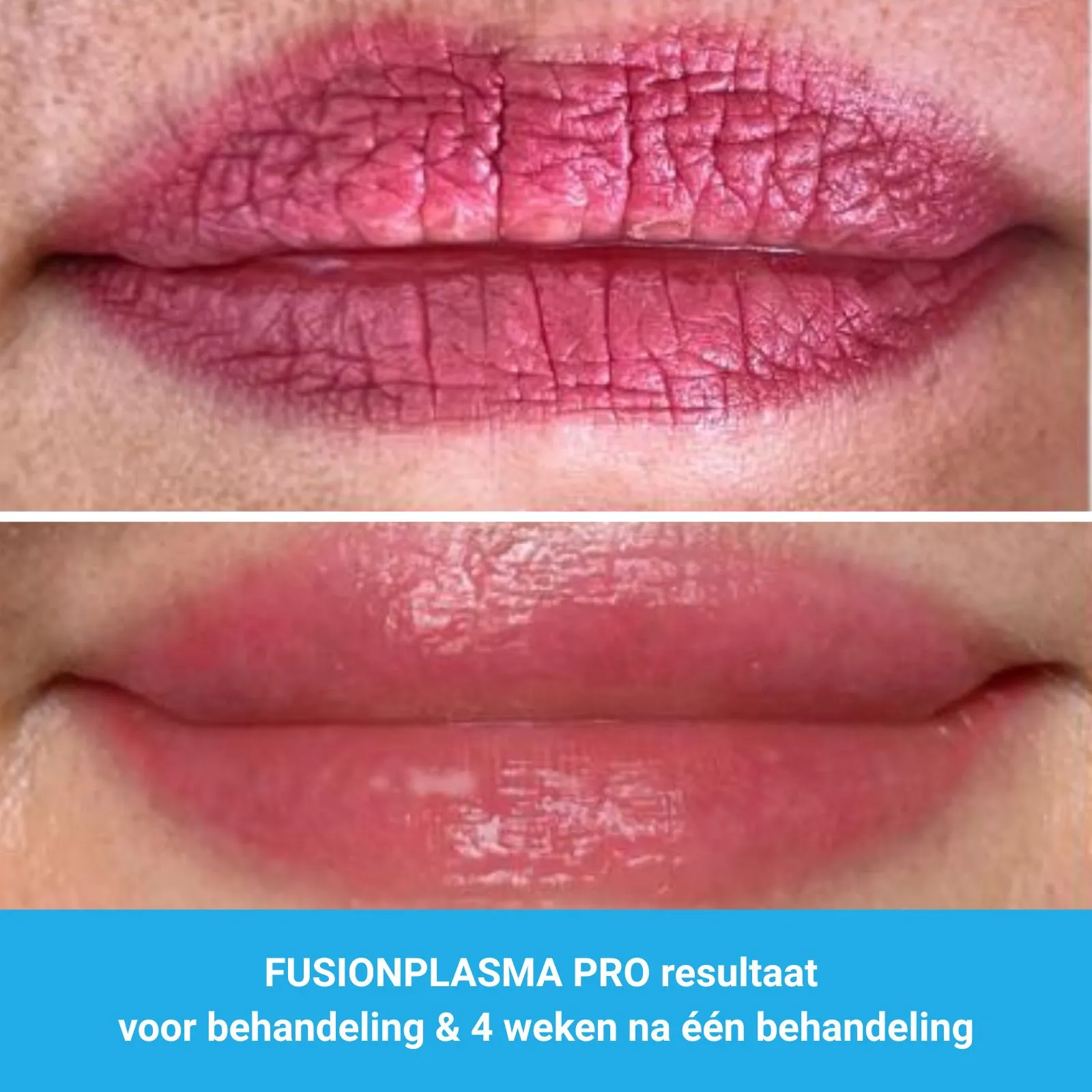resultaten lipen rejuvenation met FusionPlasma Pro van MedAes- M01- voor behandeling & 4 weken na één behandeling resultaten lipen rejuvenation met FusionPlasma Pro van MedAes- M01- voor behandeling & 4 weken na één behandeling