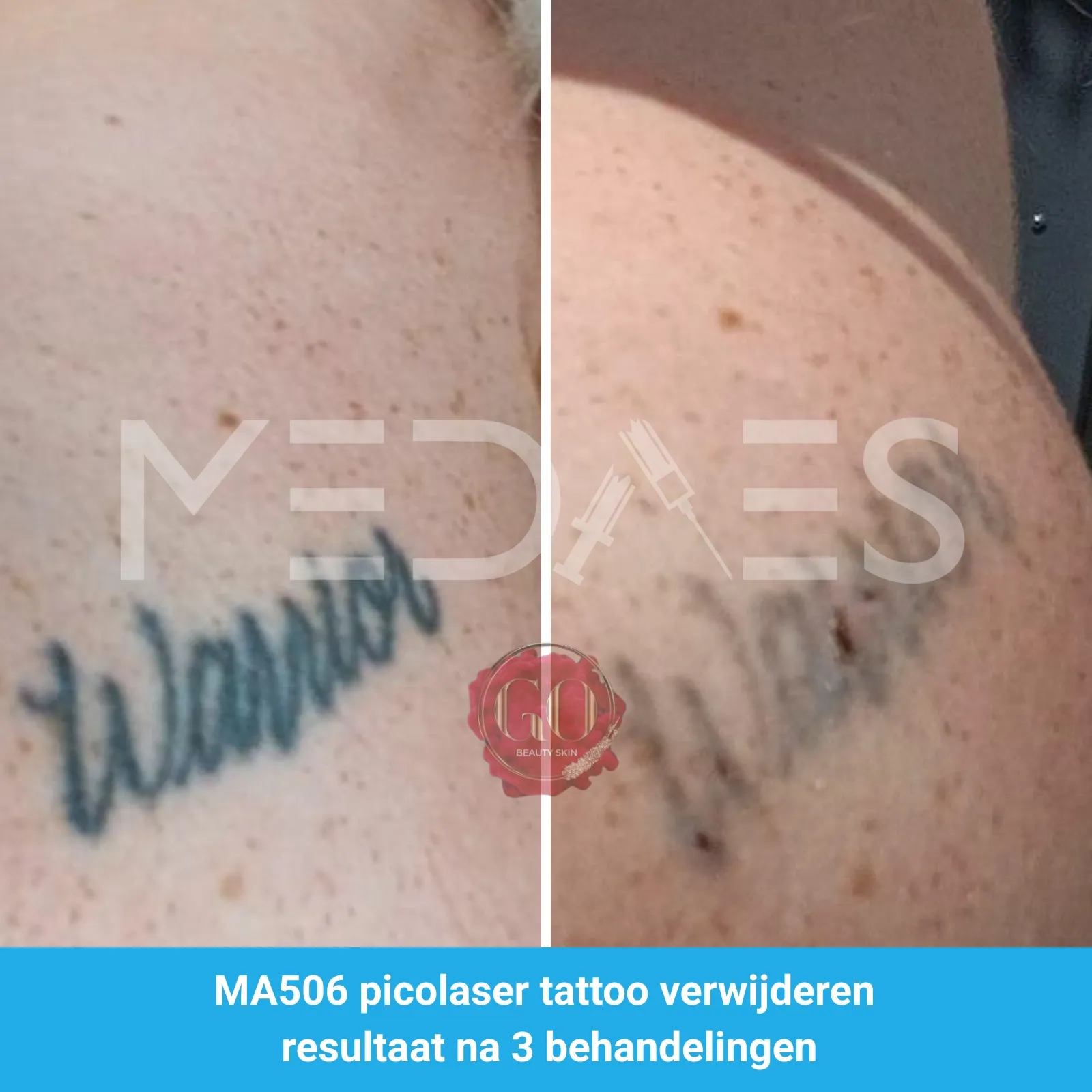 resultaten tattoo verwijderen met MA506A picolaser van MedAes Beauty Skin Go-M02-voor en na 6 weken na derde behandeling-01