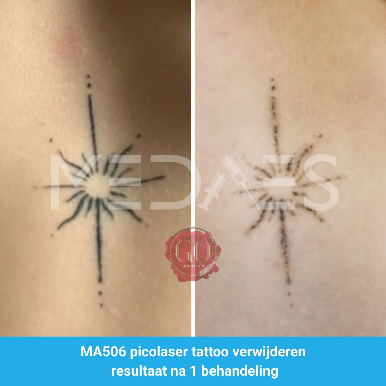 resultaten-tattoo-verwijderen-met-MA506B-picolaser-van-MedAes-Beauty-Skin-Go-M03-voor-en-na-6-weken-na-eerste-behandeling-01
