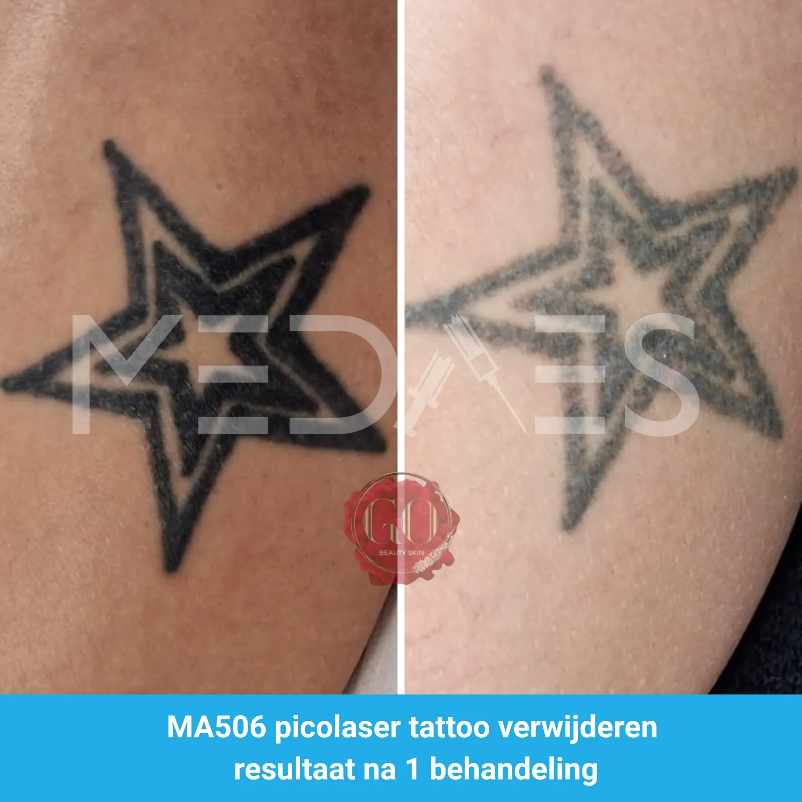 resultaten-tattoo-verwijderen-met-MA506B-picolaser-van-MedAes-Beauty-Skin-Go-M04-voor-en-na-6-weken-na-eerste-behandeling-01