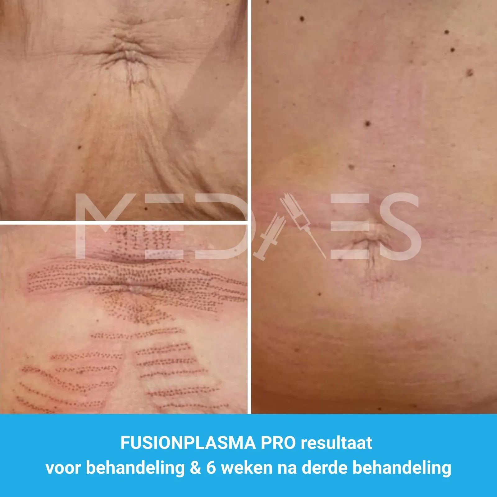 resultaten verwijdering van striae met FusionPlasma Pro van MedAes- M04- voor behandeling & 6 weken na derde behandeling resultaten verwijdering van striae met FusionPlasma Pro van MedAes- M04- voor behandeling & 6 weken na derde behandeling
