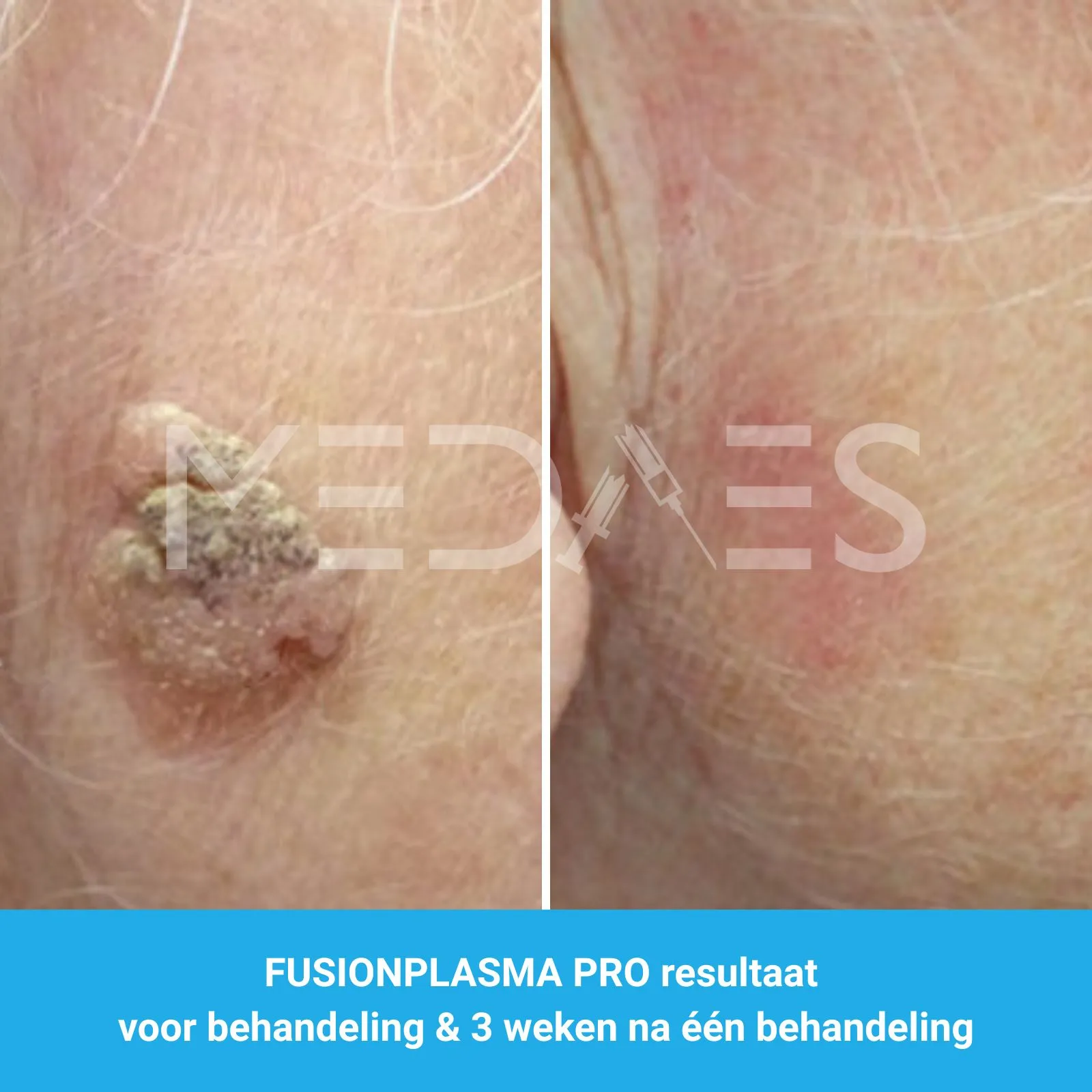 resultaten wratten verwijderen met FusionPlasma Pro van MedAes- M02- voor behandeling & 3 weken na één behandeling resultaten wratten verwijderen met FusionPlasma Pro van MedAes- M02- voor behandeling & 3 weken na één behandeling
