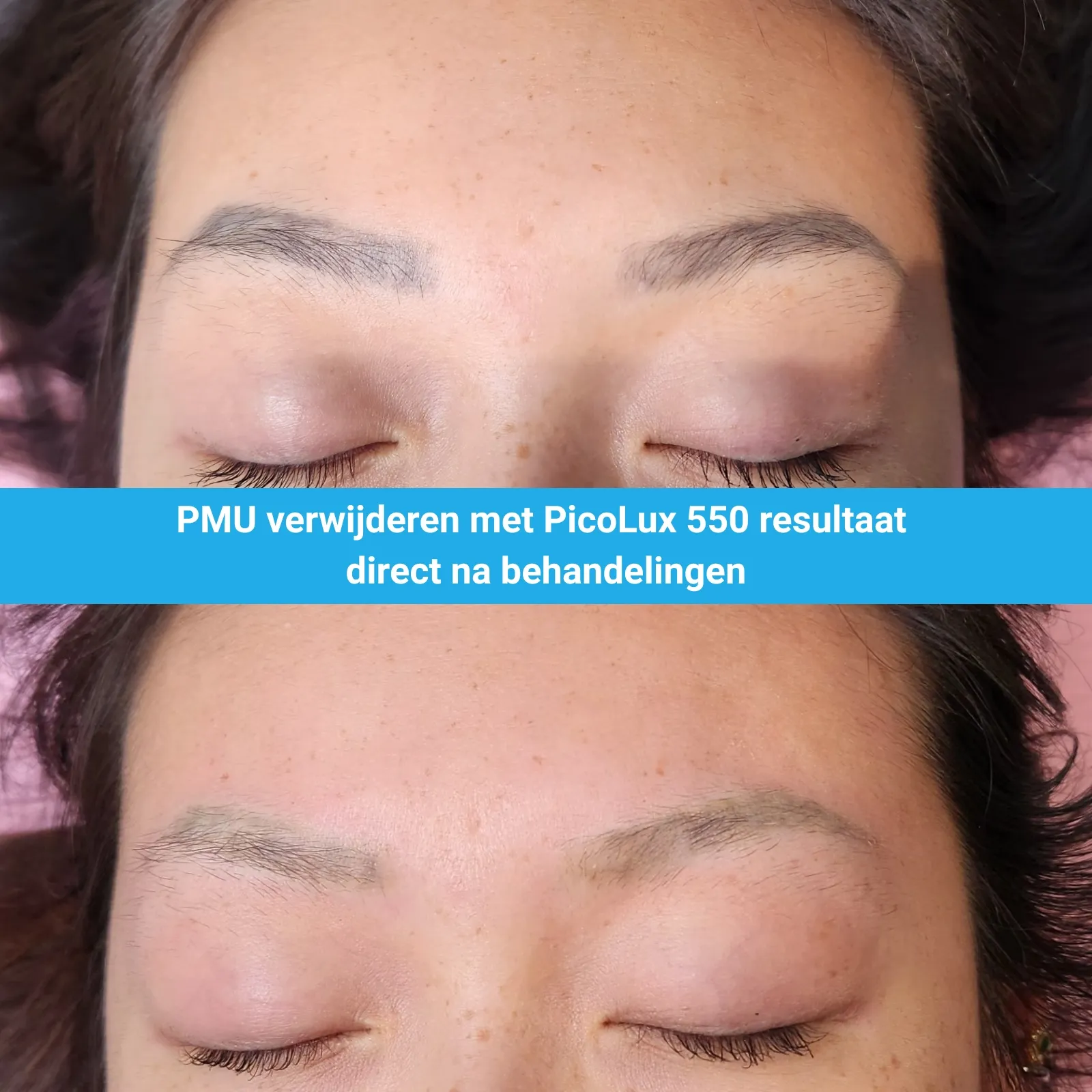 PMU verwijderen Laser Skin Studio met PicoLux 550 van MedAes resultaat na 1 behandelingen M02