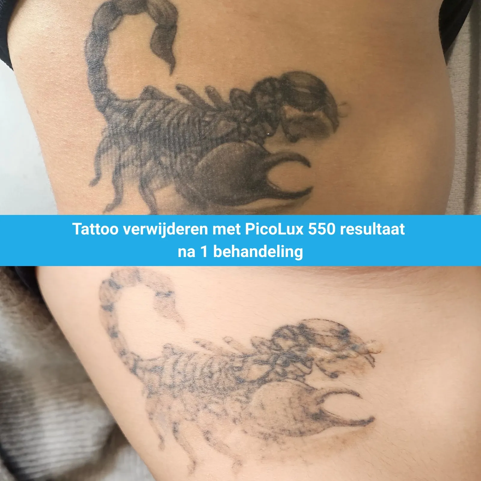 Tattoo verwijderen Laser Skin Studio met PicoLux 550 van MedAes resultaat na 1 behandelingen M01