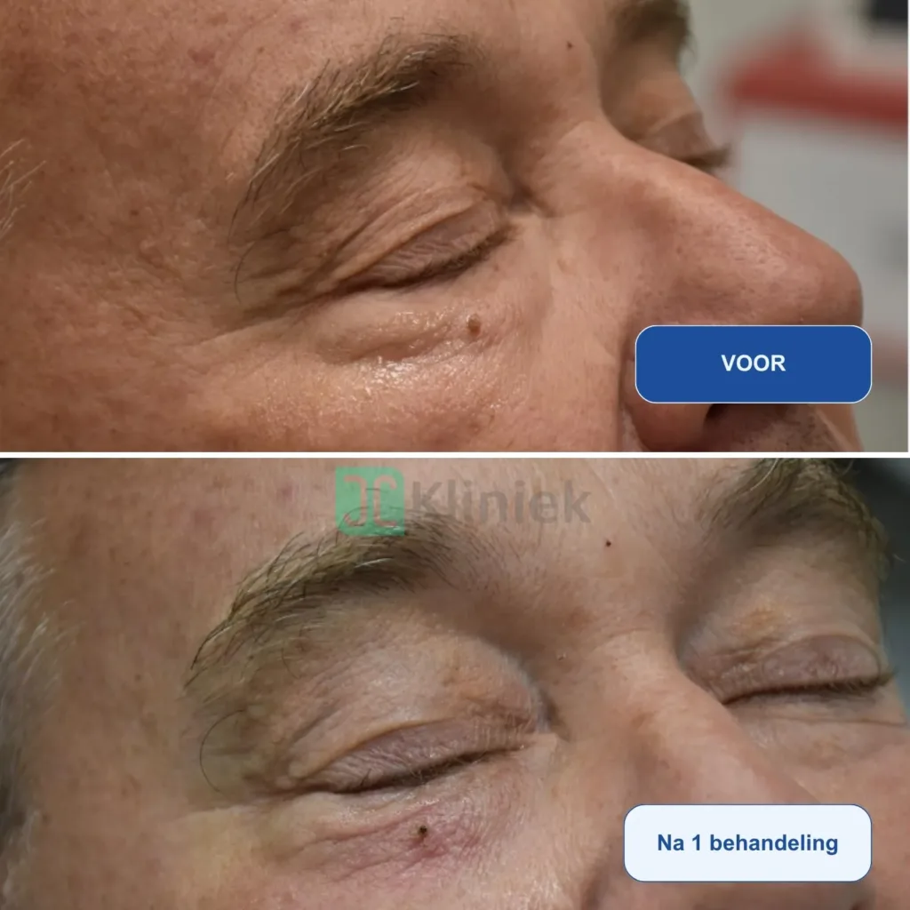 Resultaat Lumina RF900 fractionele CO2 van MedAes- JC Kliniek- voor en na 1 begandeling M03