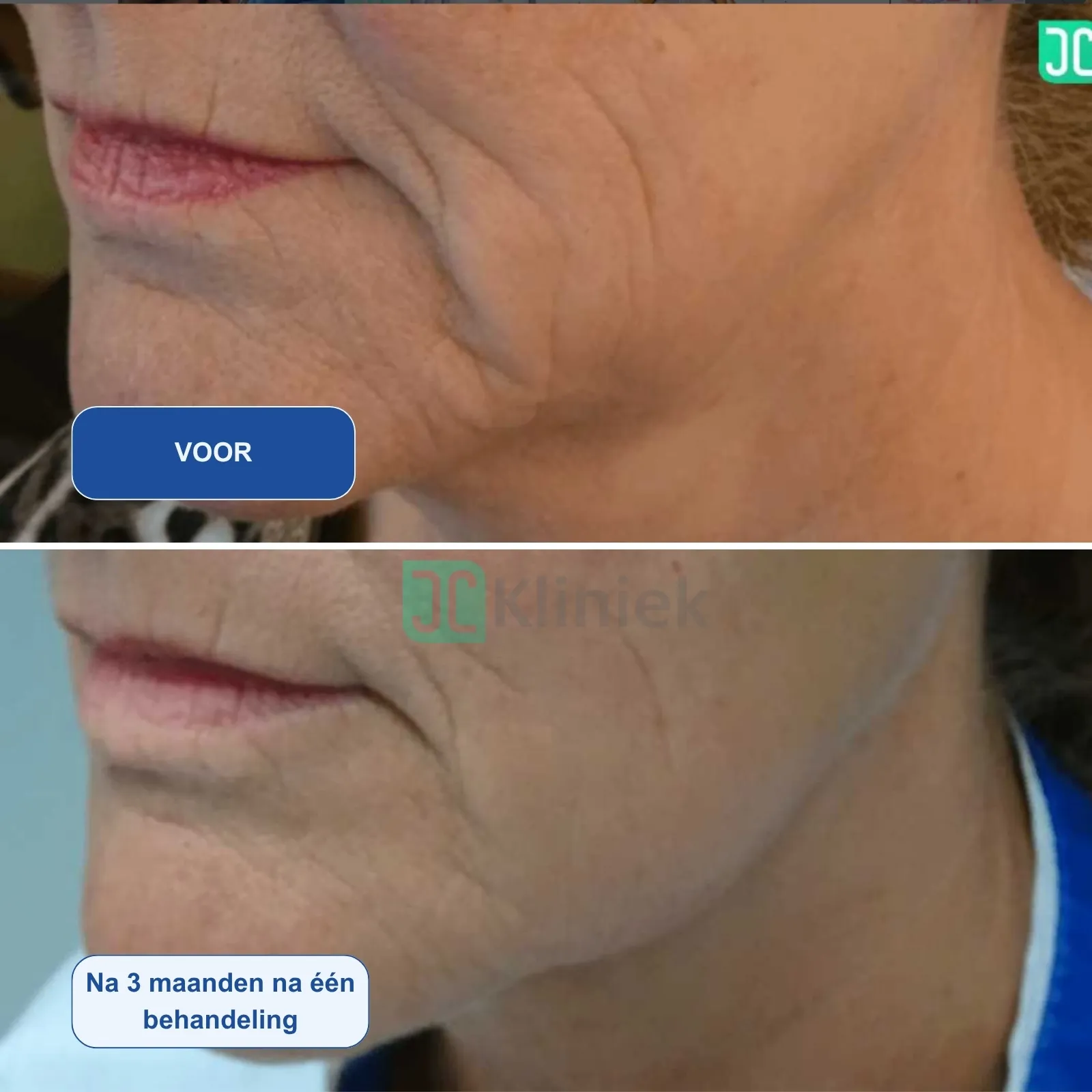 Resultaten-HIFU 8D+RF-JC Kliniek-M01-voor en na 1 behandeling