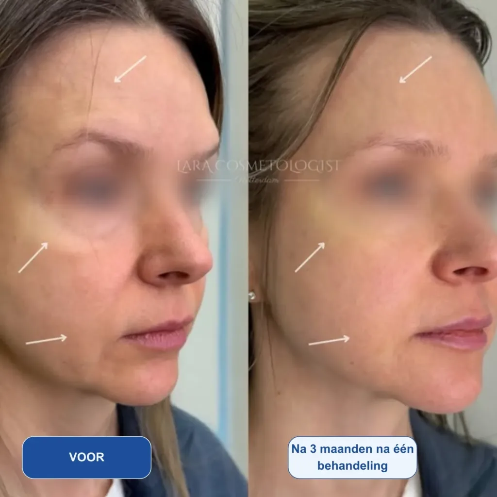 Resultaten-HIFU 8D+RF-Lara Cosmetologist-M01-voor en na 1 behandeling Resultaten-HIFU 8D+RF-Lara Cosmetologist-M01-voor en na 1 behandeling