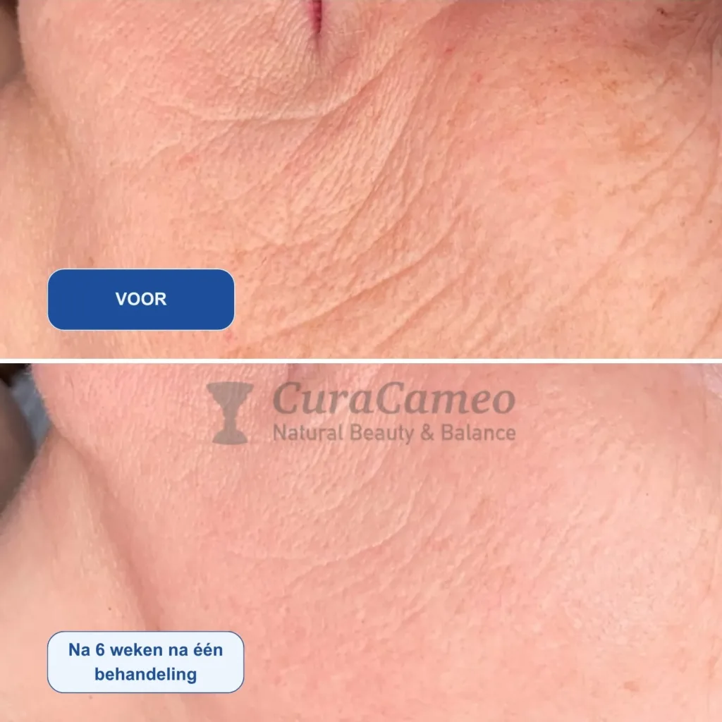 Resultaten-Microneedling met BioPen Q2-CuraCameo-M01-voor en na 6 weken na één behandeling