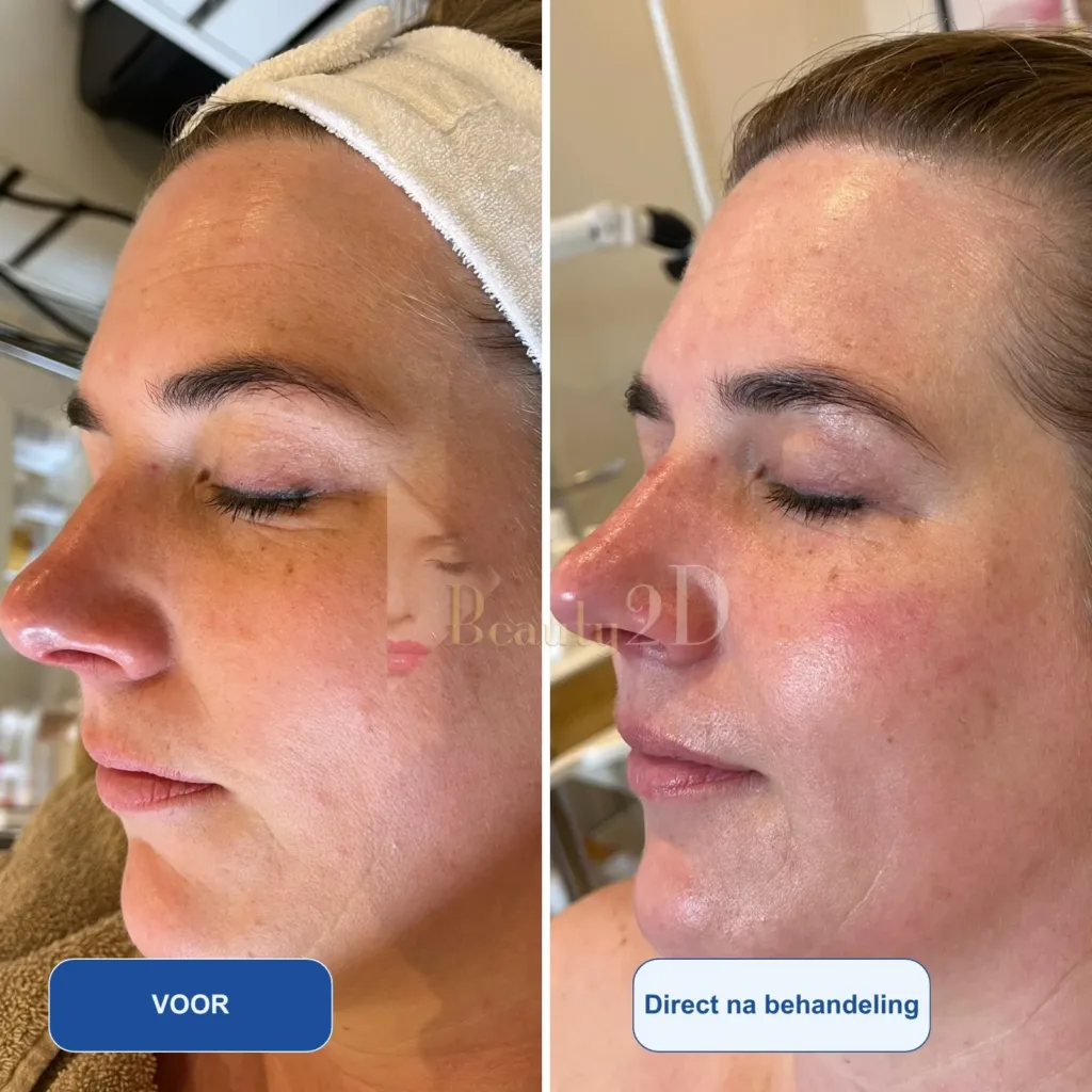 Resultaten microneedling dr-pen-a20-dermelix-pdrn-2-procent- Beauty2D-body-contouring kliniek Resultaten microneedling dr-pen-a20-dermelix-pdrn-2-procent- Beauty2D-body-contouring kliniek