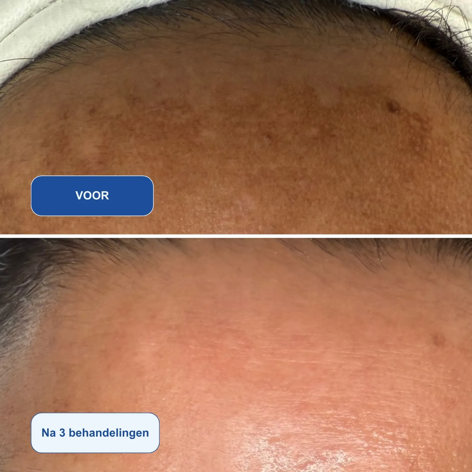 resultaten Algen Peeling met Dermelix BP-002 - voor en na 3 behandelingen